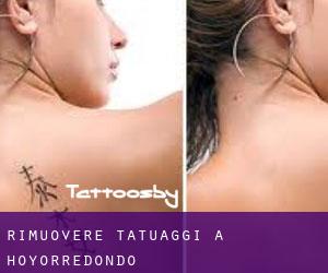 Rimuovere Tatuaggi a Hoyorredondo