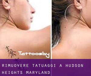 Rimuovere Tatuaggi a Hudson Heights (Maryland)