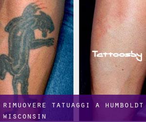 Rimuovere Tatuaggi a Humboldt (Wisconsin)