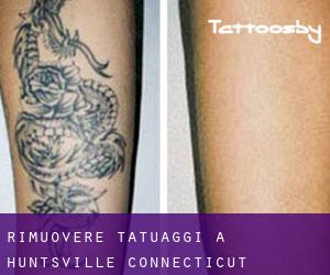 Rimuovere Tatuaggi a Huntsville (Connecticut)