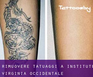 Rimuovere Tatuaggi a Institute (Virginia Occidentale)