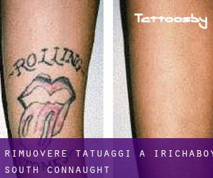 Rimuovere Tatuaggi a Irichaboy South (Connaught)