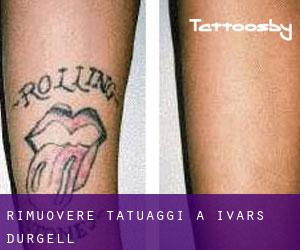 Rimuovere Tatuaggi a Ivars d'Urgell