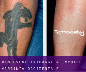 Rimuovere Tatuaggi a Ivydale (Virginia Occidentale)