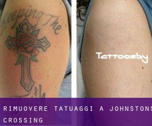 Rimuovere Tatuaggi a Johnstons Crossing