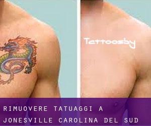 Rimuovere Tatuaggi a Jonesville (Carolina del Sud)