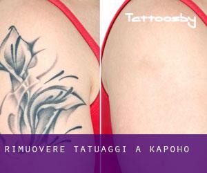 Rimuovere Tatuaggi a Kapoho
