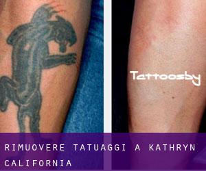 Rimuovere Tatuaggi a Kathryn (California)