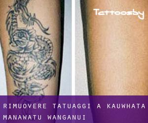 Rimuovere Tatuaggi a Kauwhata (Manawatu-Wanganui)