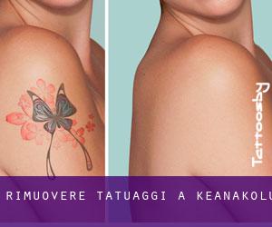 Rimuovere Tatuaggi a Keanakolu