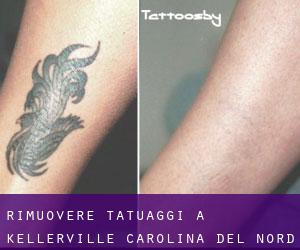 Rimuovere Tatuaggi a Kellerville (Carolina del Nord)