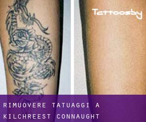 Rimuovere Tatuaggi a Kilchreest (Connaught)