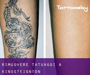 Rimuovere Tatuaggi a Kingsteignton