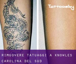 Rimuovere Tatuaggi a Knowles (Carolina del Sud)