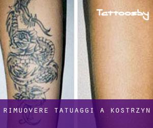 Rimuovere Tatuaggi a Kostrzyn