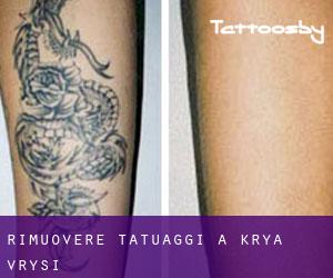 Rimuovere Tatuaggi a Krýa Vrýsi