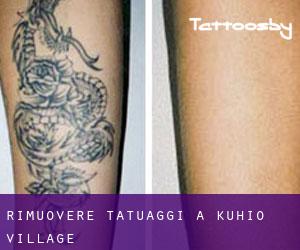 Rimuovere Tatuaggi a Kuhio Village