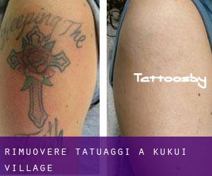 Rimuovere Tatuaggi a Kukui Village