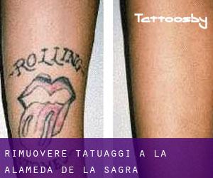 Rimuovere Tatuaggi a La Alameda de la Sagra