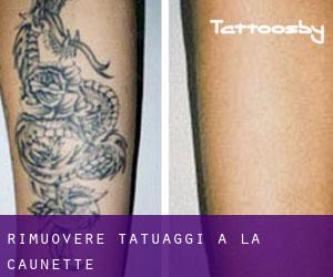 Rimuovere Tatuaggi a La Caunette