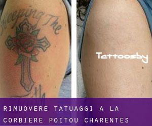 Rimuovere Tatuaggi a La Corbière (Poitou-Charentes)