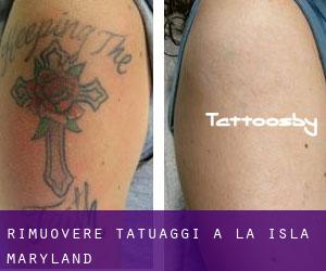 Rimuovere Tatuaggi a La Isla (Maryland)