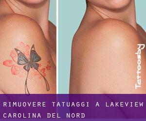 Rimuovere Tatuaggi a Lakeview (Carolina del Nord)