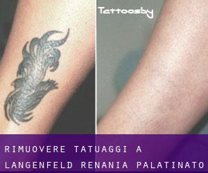 Rimuovere Tatuaggi a Langenfeld (Renania-Palatinato)