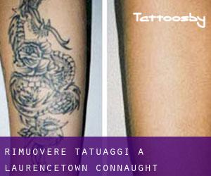 Rimuovere Tatuaggi a Laurencetown (Connaught)