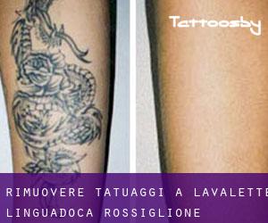 Rimuovere Tatuaggi a Lavalette (Linguadoca-Rossiglione)