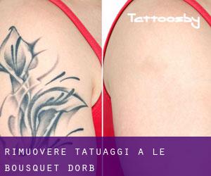 Rimuovere Tatuaggi a Le Bousquet-d'Orb