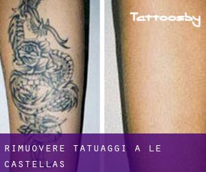 Rimuovere Tatuaggi a Le Castellas