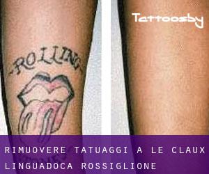 Rimuovere Tatuaggi a Le Claux (Linguadoca-Rossiglione)