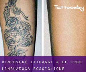 Rimuovere Tatuaggi a Le Cros (Linguadoca-Rossiglione)