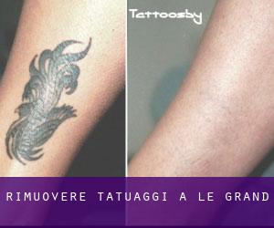 Rimuovere Tatuaggi a Le Grand
