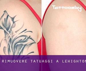 Rimuovere Tatuaggi a Lehighton