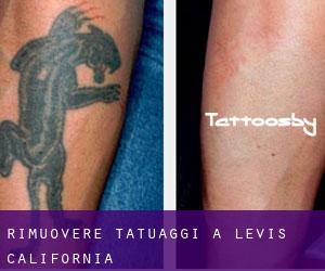 Rimuovere Tatuaggi a Levis (California)