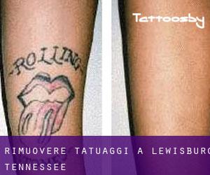 Rimuovere Tatuaggi a Lewisburg (Tennessee)