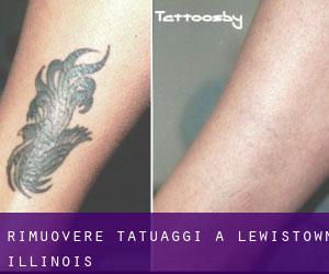 Rimuovere Tatuaggi a Lewistown (Illinois)