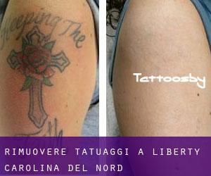 Rimuovere Tatuaggi a Liberty (Carolina del Nord)