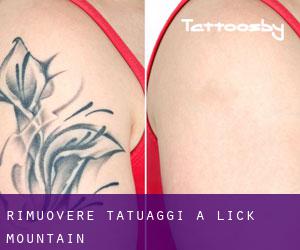 Rimuovere Tatuaggi a Lick Mountain