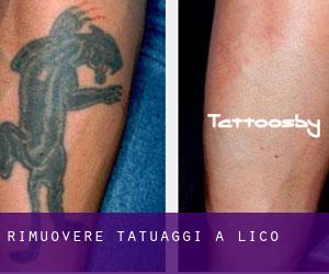 Rimuovere Tatuaggi a Lico