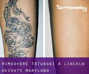 Rimuovere Tatuaggi a Lincoln Heights (Maryland)