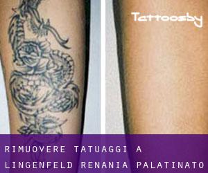 Rimuovere Tatuaggi a Lingenfeld (Renania-Palatinato)