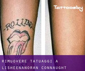 Rimuovere Tatuaggi a Lisheenanoran (Connaught)