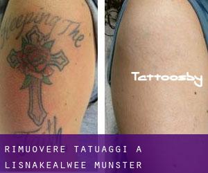 Rimuovere Tatuaggi a Lisnakealwee (Munster)