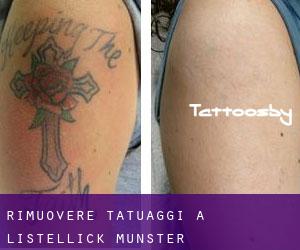 Rimuovere Tatuaggi a Listellick (Munster)