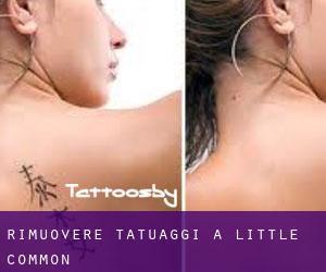 Rimuovere Tatuaggi a Little Common
