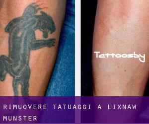 Rimuovere Tatuaggi a Lixnaw (Munster)