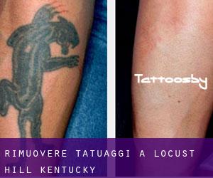 Rimuovere Tatuaggi a Locust Hill (Kentucky)